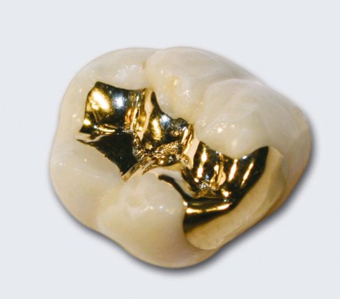 Füllungen goldinlay.jpg